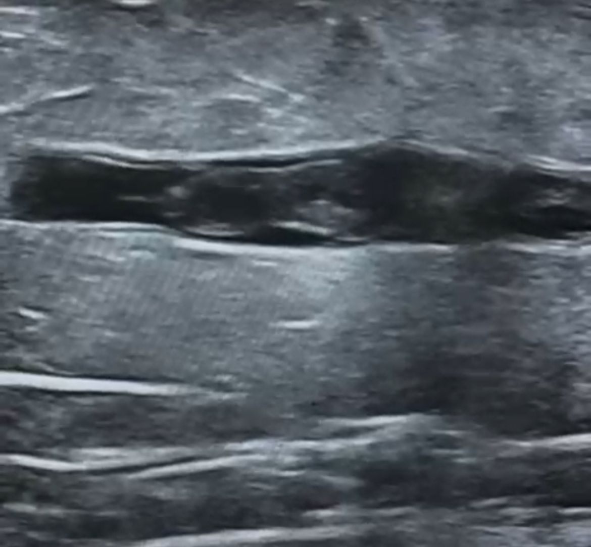 В Мангистау врачи за 13 минут удалили опасный для жизни пациента тромб