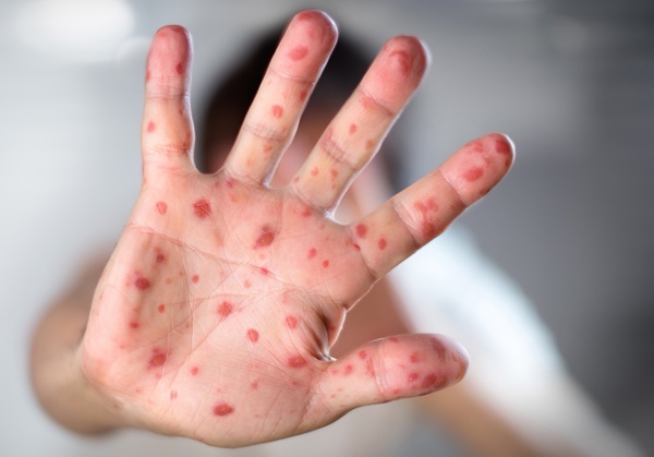 В Казахстане снизилось число заражений корью